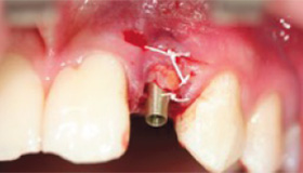 Implantation mit Sofortbelastung