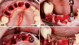 Sofortbelastete Implantatprothetik im ästhetischen Bereich