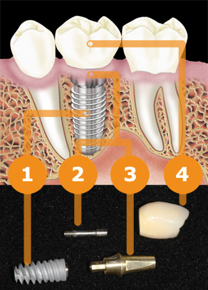 Implantat schematische Darstellung