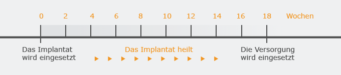 Zeitplan für die Behandlung mit einem Zahnimplantat